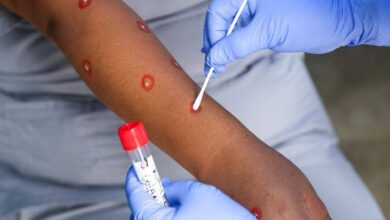 43 casos de pacientes con viruela simica 220822