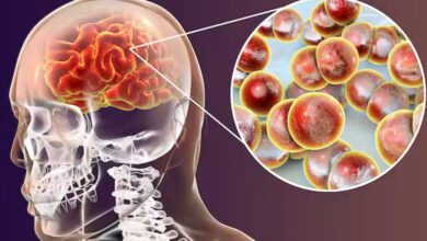 MENINGITIS RRSS