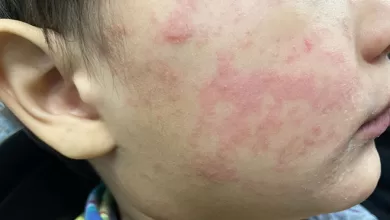 Brote de sarampión en Bolivia, siguen creciendo los casos