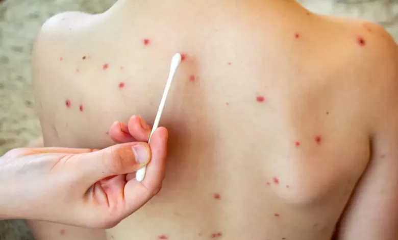 Sarampión en niños